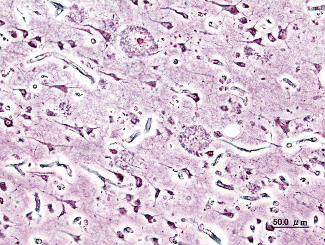 File:Alzheimer dementia (3) presenile onset.jpg
